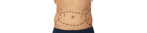 tummy tuck cost in tijuana|Tummy Tuck in Tijuana, Mexico